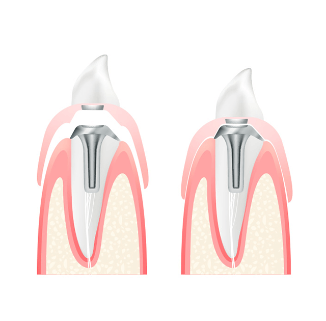 マグネットデンチャー