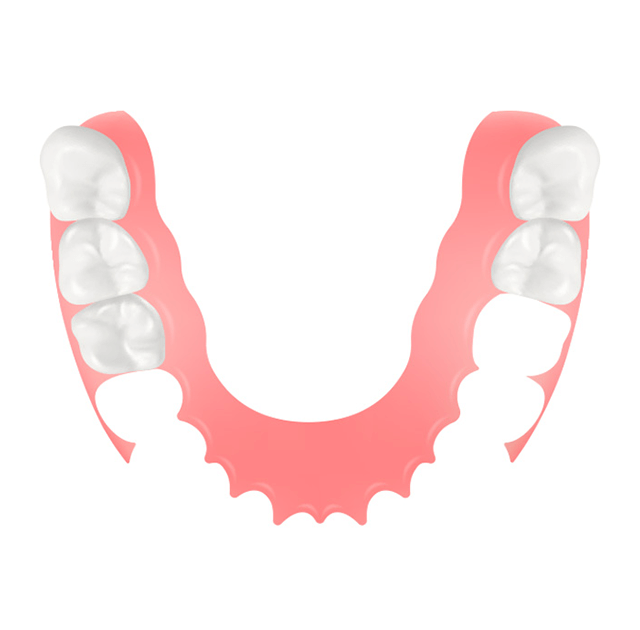 ノンクラスプデンチャー